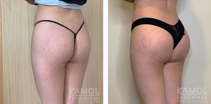 Buttock Augmentation 400 CC