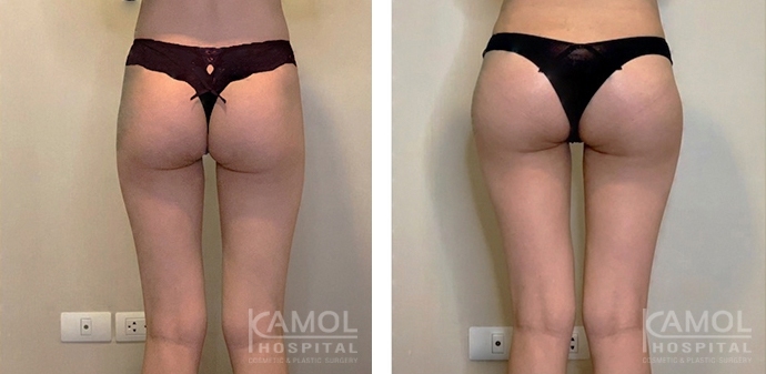 Buttock Augmentation 400 CC