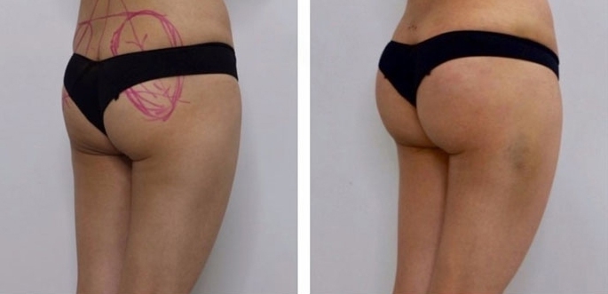 Buttock Augmentation 300 CC