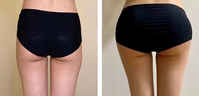 Buttock Augmentation 300 CC