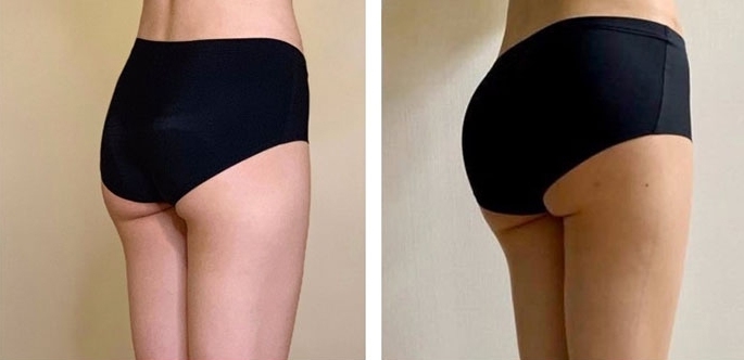 Buttock Augmentation 300 CC