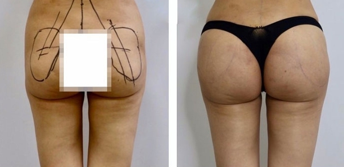 Buttock Augmentation 450 CC