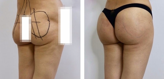 Buttock Augmentation 450 CC