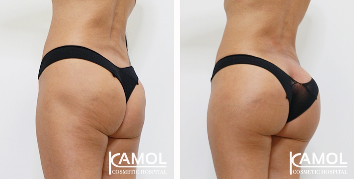 Buttock Augmentation 360 CC