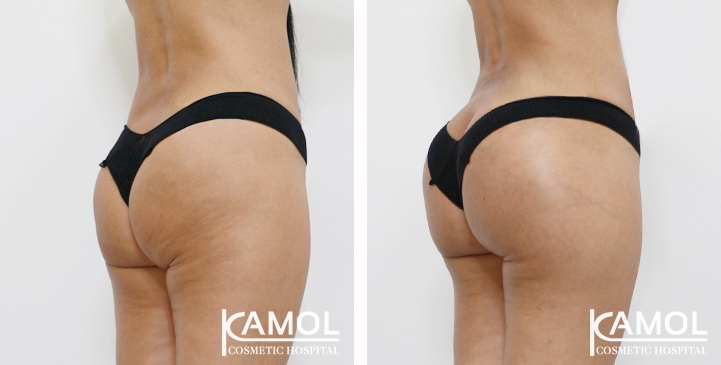 Buttock Augmentation 360 CC