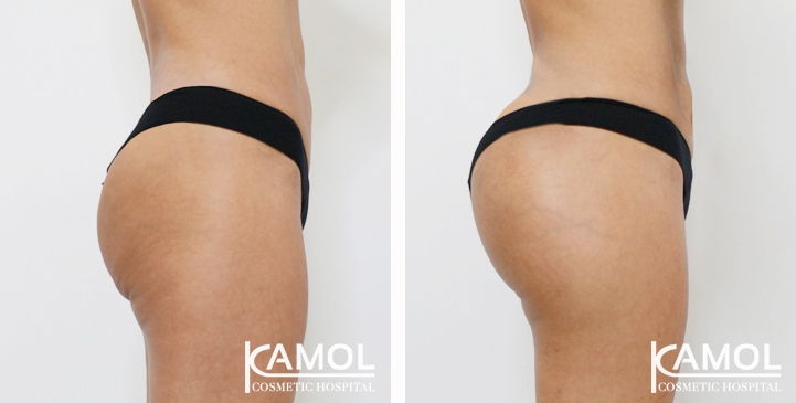 Buttock Augmentation 360 CC