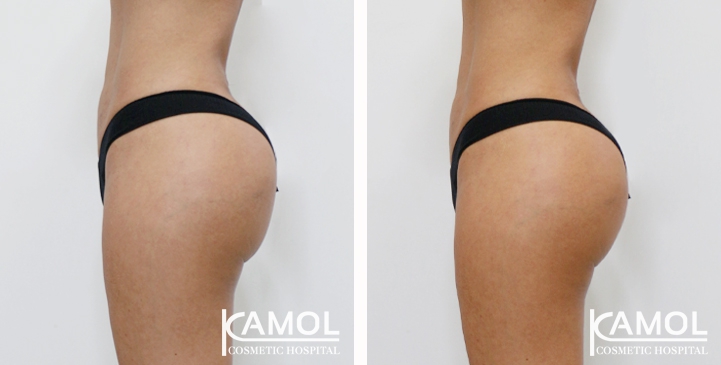 Buttock Augmentation 360 CC