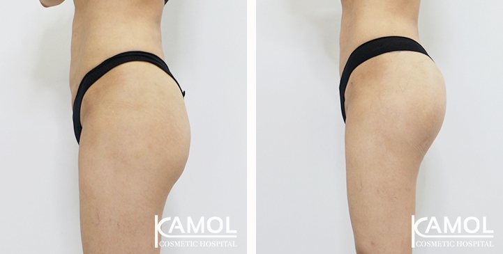 Buttock Augmentation 360 CC