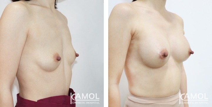 Breast Augmentation