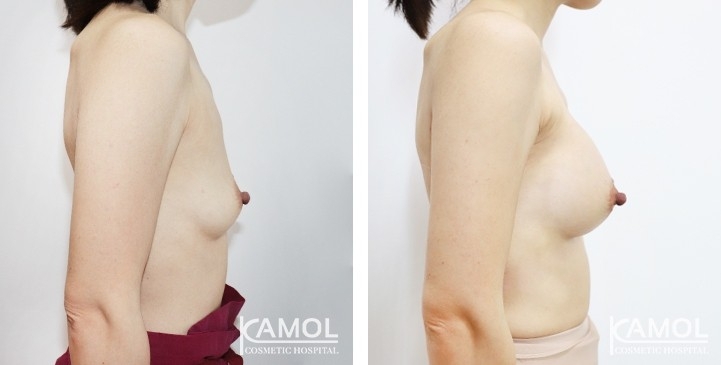 Breast Augmentation