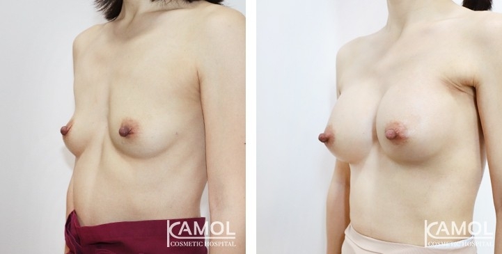 Breast Augmentation