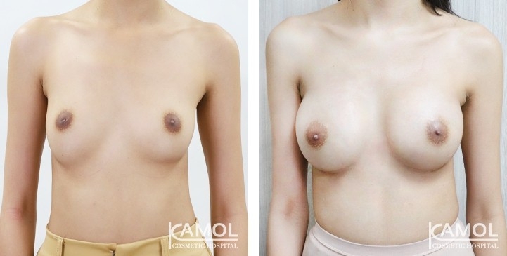 Breast Augmentation