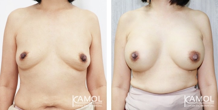 Breast Augmentation