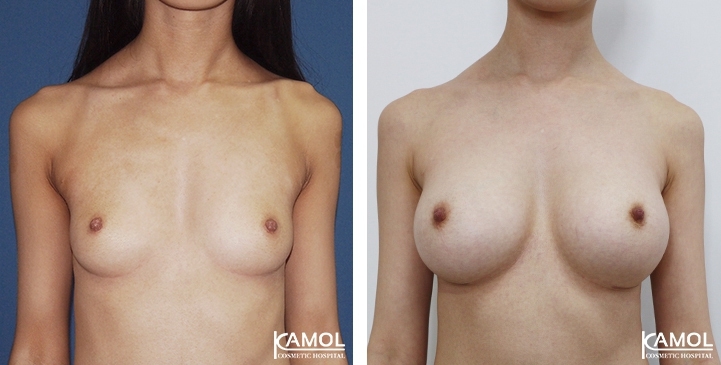 Breast Augmentation