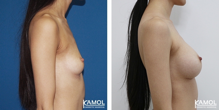 Breast Augmentation