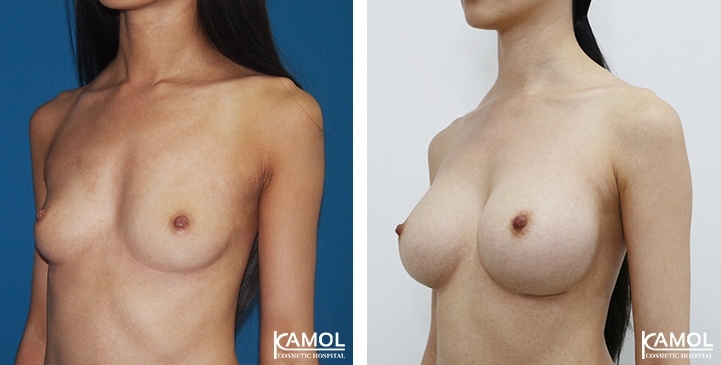 Breast Augmentation