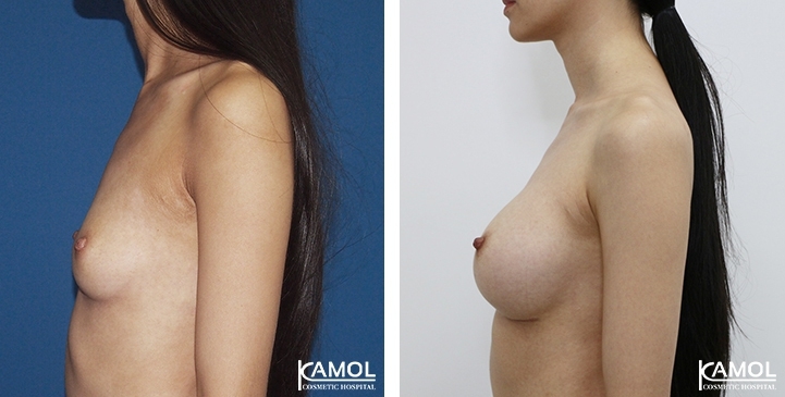 Breast Augmentation