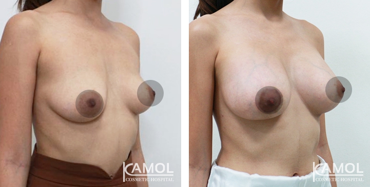 Breast Augmentation