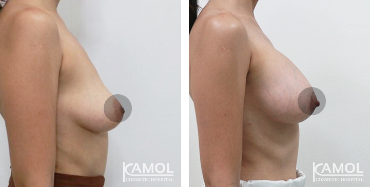 Breast Augmentation