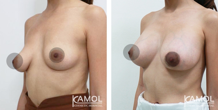 Breast Augmentation