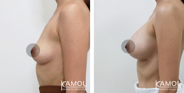 Breast Augmentation