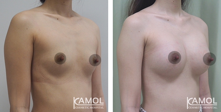 Breast Augmentation