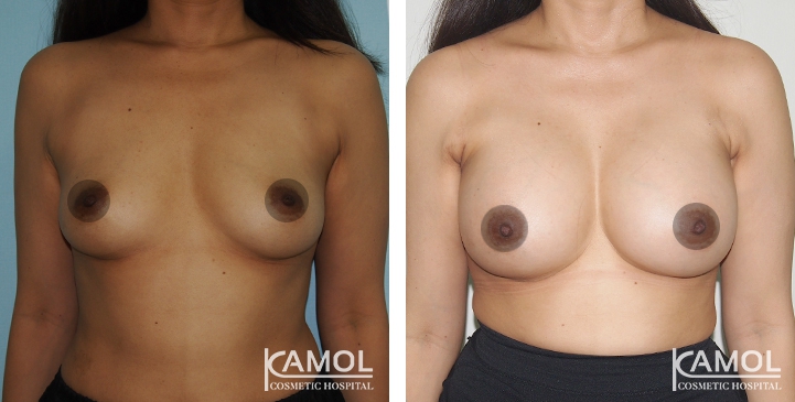 Breast Augmentation