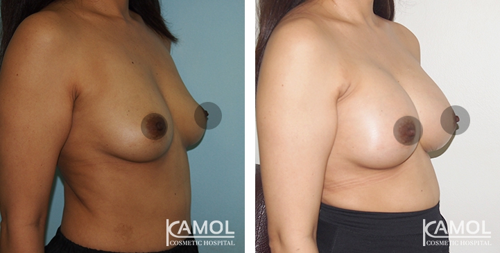 Breast Augmentation