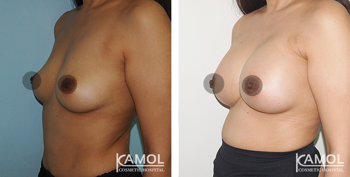 Breast Augmentation