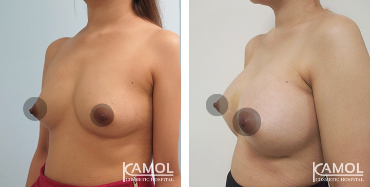 Breast Augmentation