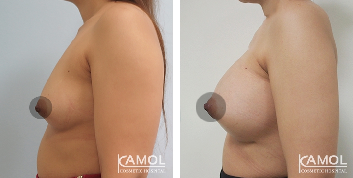 Breast Augmentation