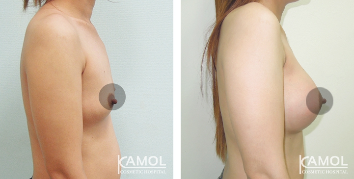 Breast Augmentation