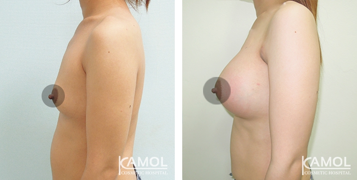 Breast Augmentation