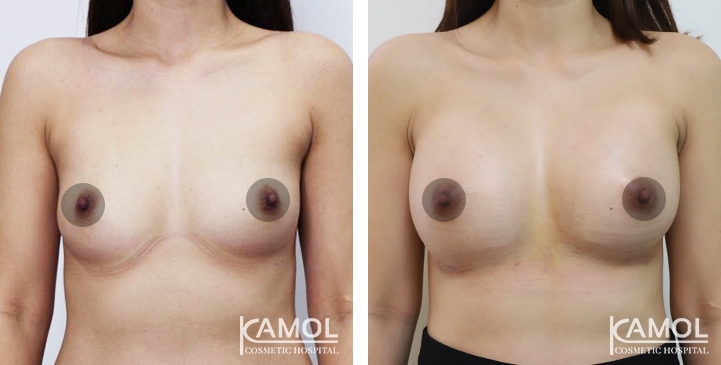 Breast Augmentation