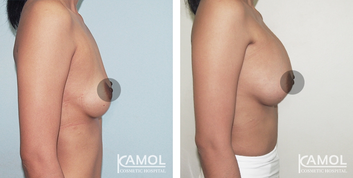 Breast Augmentation