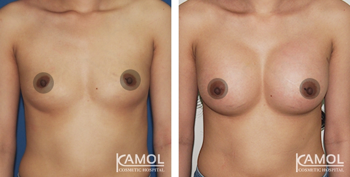 Breast Augmentation