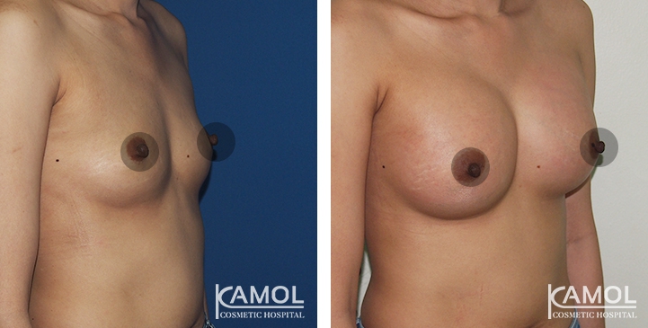 Breast Augmentation