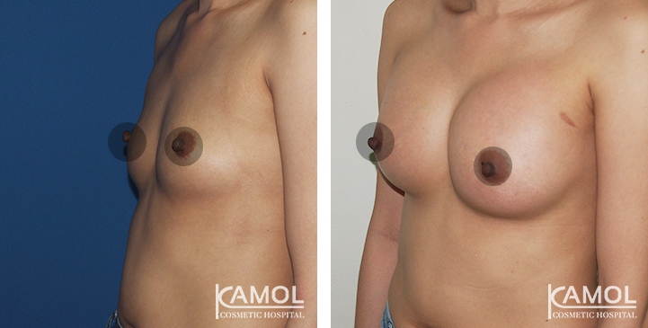 Breast Augmentation