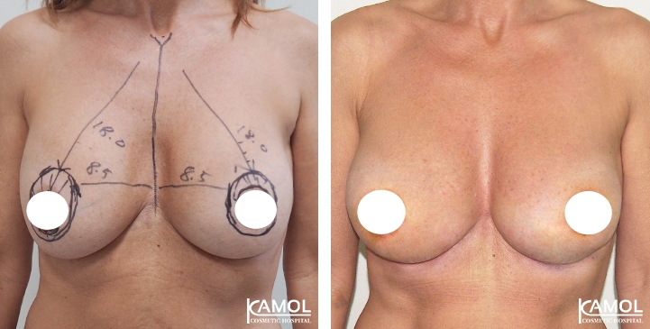 Breast Lift by Incision Scar around Areola (O scar)