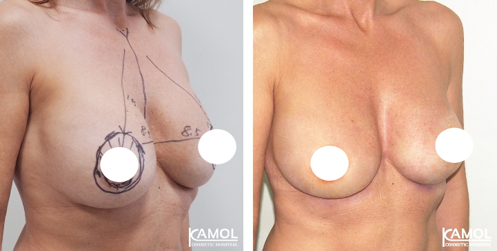 Breast Lift by Incision Scar around Areola (O scar)