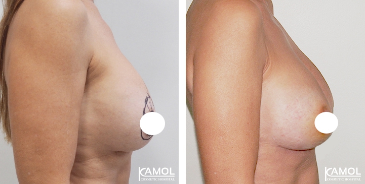 Breast Lift by Incision Scar around Areola (O scar)