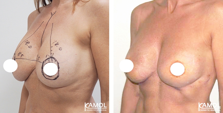 Breast Lift by Incision Scar around Areola (O scar)