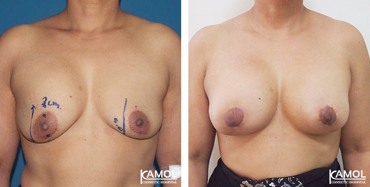 Breast Lift by Incision Scar around Areola (O scar) with implant
