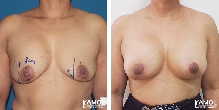 Breast Lift by Incision Scar around Areola (O scar) with implant 