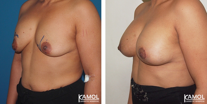 Breast Lift by Incision Scar around Areola (O scar) with implant