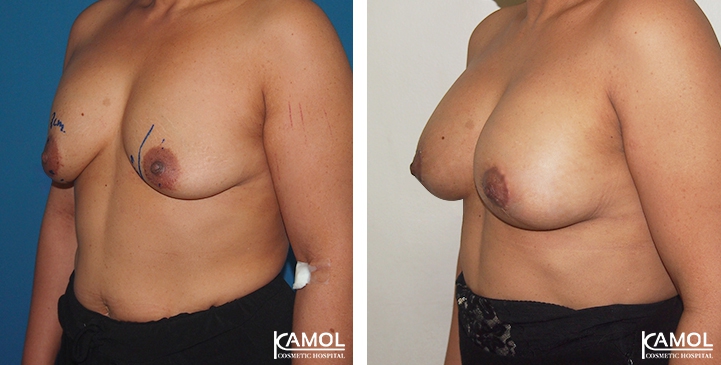 Breast Lift by Incision Scar around Areola (O scar) with implant 