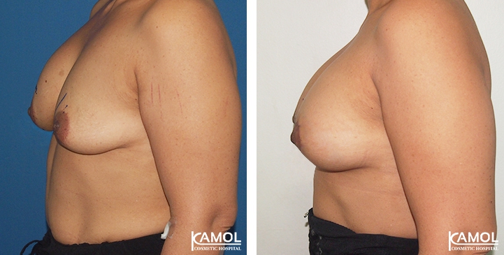 Breast Lift by Incision Scar around Areola (O scar) with implant /p>