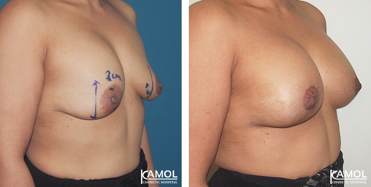 Breast Lift by Incision Scar around Areola (O scar) with implant