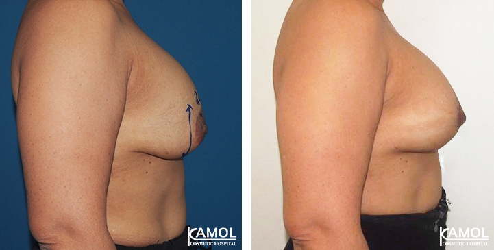 Breast Lift by Incision Scar around Areola (O scar) with implant /p>