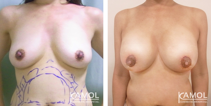 Breast Lift by Incision Scar around Areola (O scar) with implant 